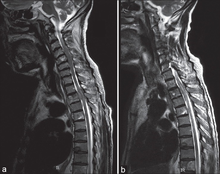 MRI spine
