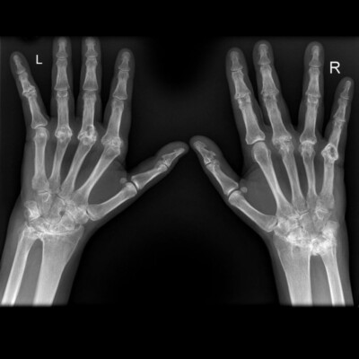 MRI hand