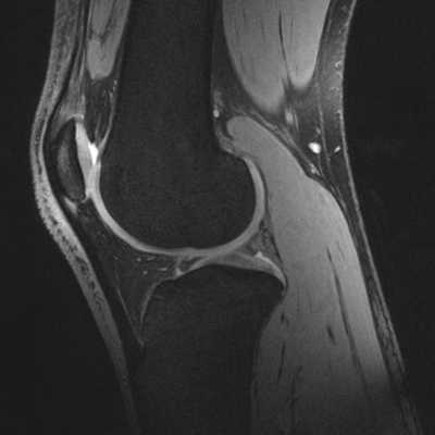 Knee mri