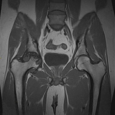 Pelvis mri