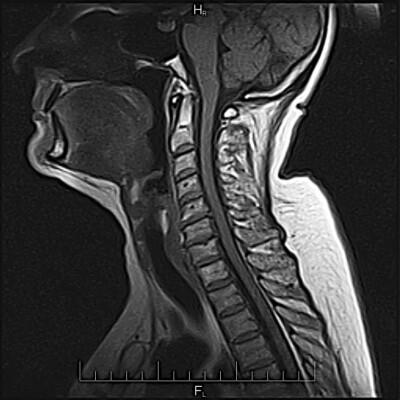 MRI neck