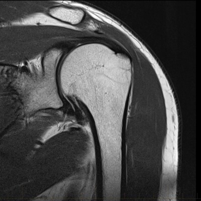 MRI Shoulder