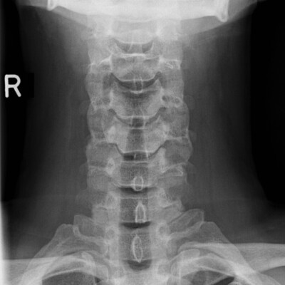 X-ray neck