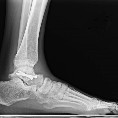 MRI foot and ankle