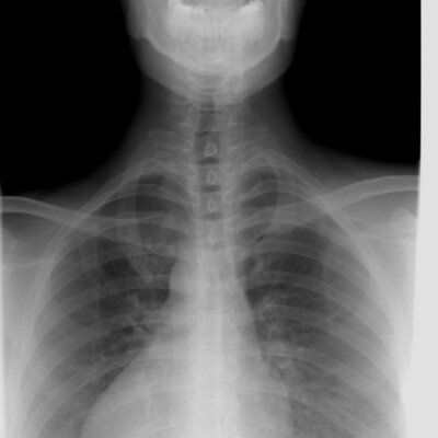 X-ray Thoracic spine