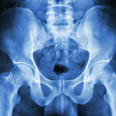 X-ray Pelvis