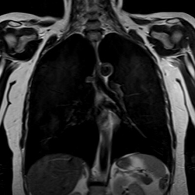 mri Chest