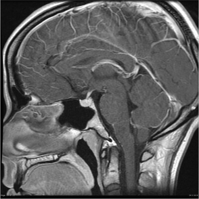 Pituitary mri