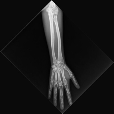 X-ray forearm